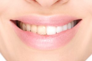 teeth whitening treatments in Bowling Green